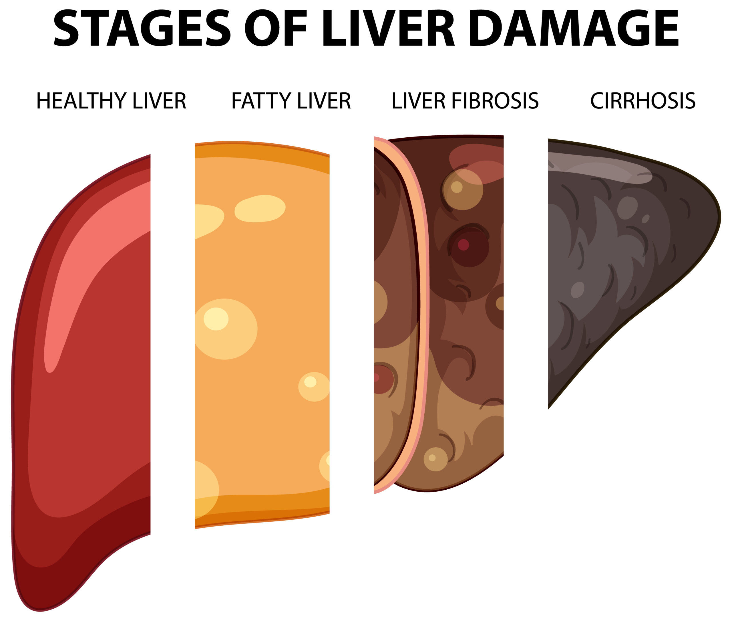 Alcoholic Liver Damage